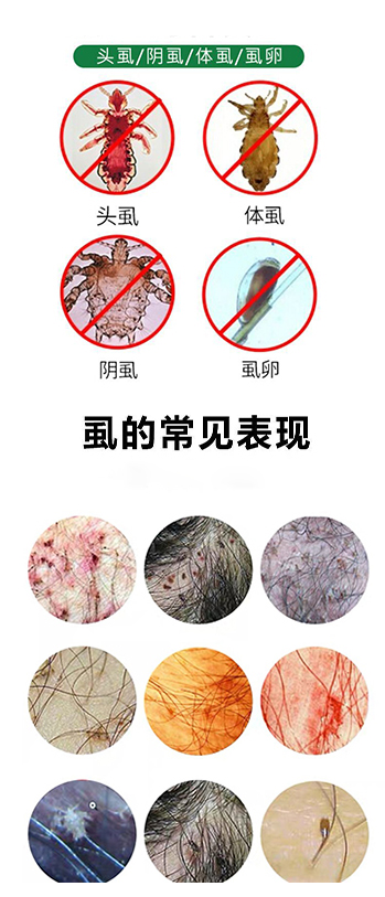 后来网上看了很多帖子,文章,说用水淹,肥皂,洗衣粉搓,白醋泡,硫软膏